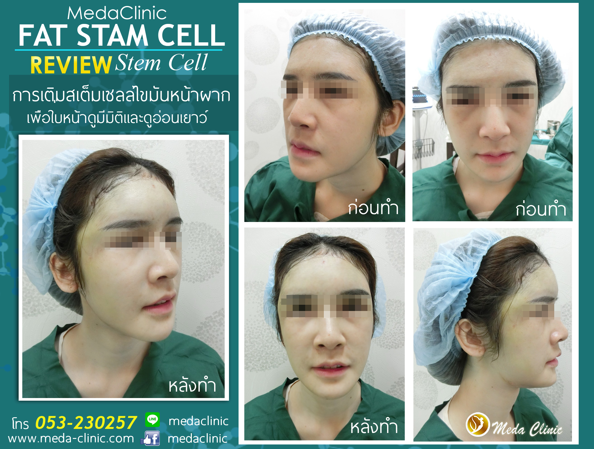 review Stem Cell ผากเคส 2 copy