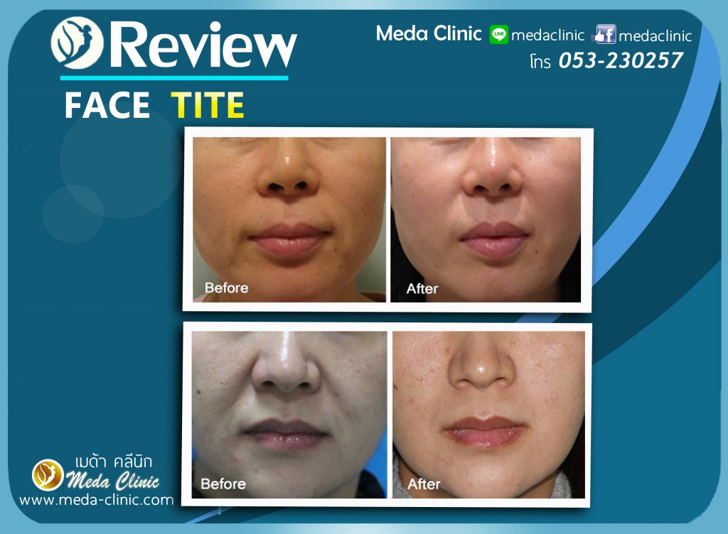 รีวิล FACE TITE 2 copy
