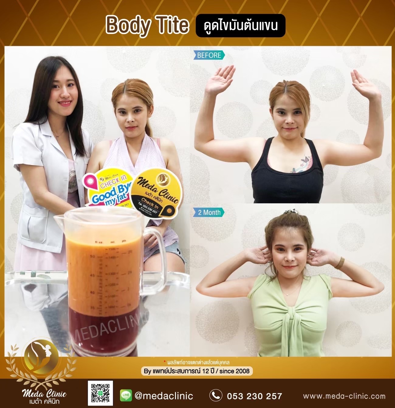 Arm liposuction Chiang Mai