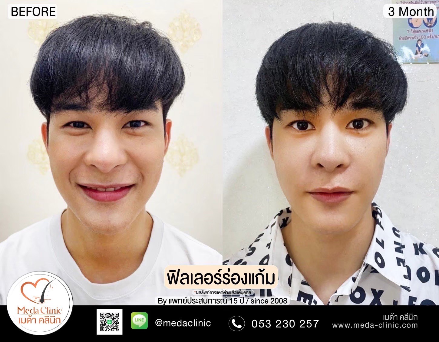 ฟิลเลอร์แก้มตอบ