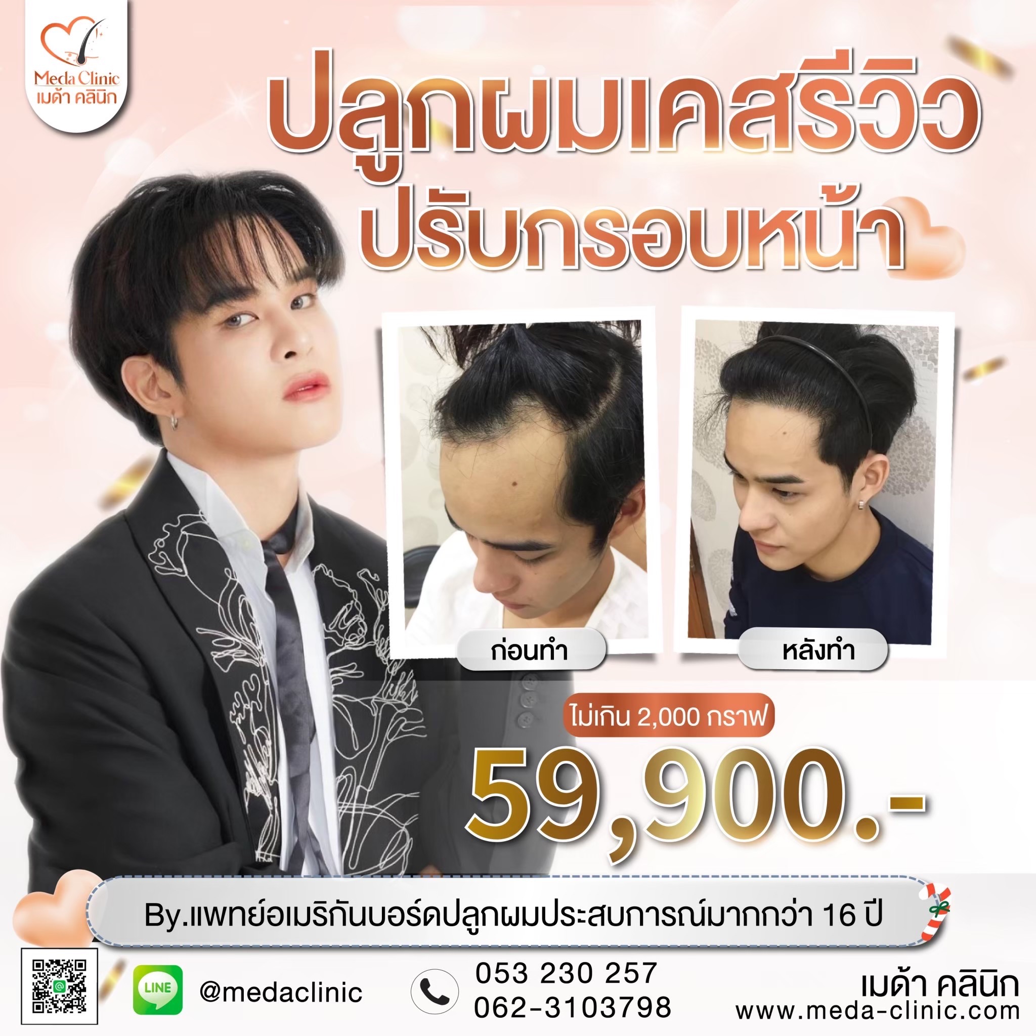 ปลูกผม