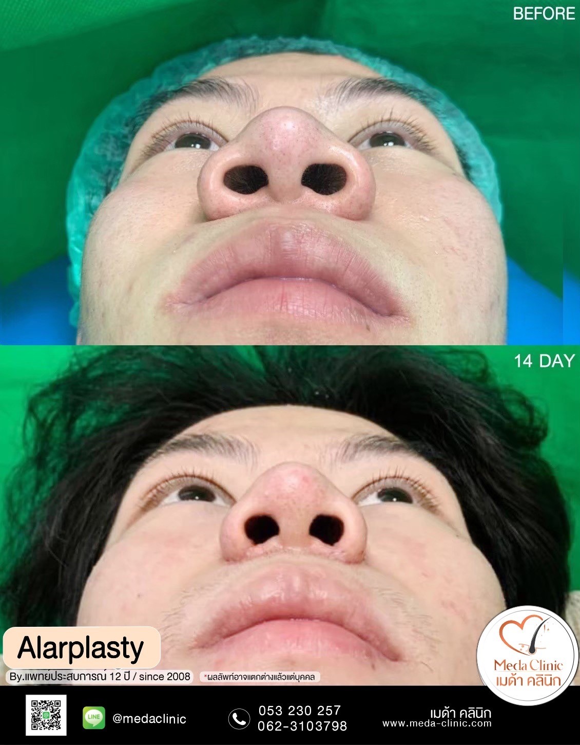 alarplasty