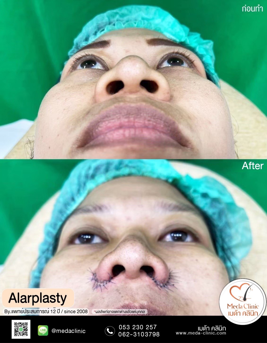 alarplasty